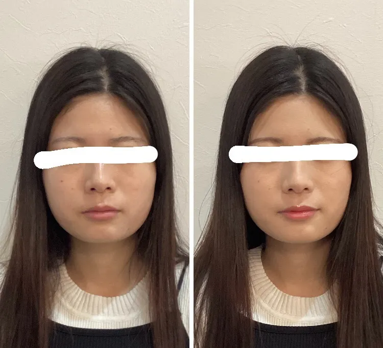 宮崎市エステ　毛穴洗浄⁺ジェーンメイク