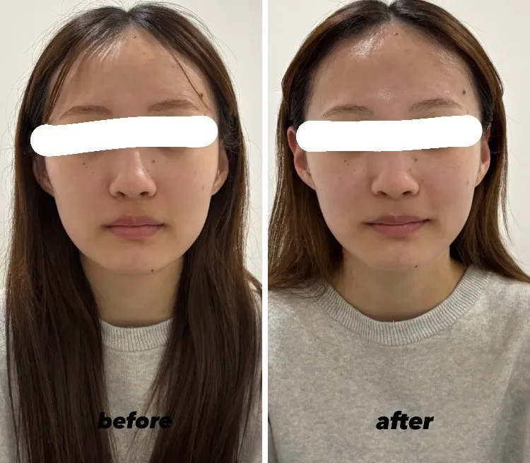 宮崎市エステ　顔面痩身