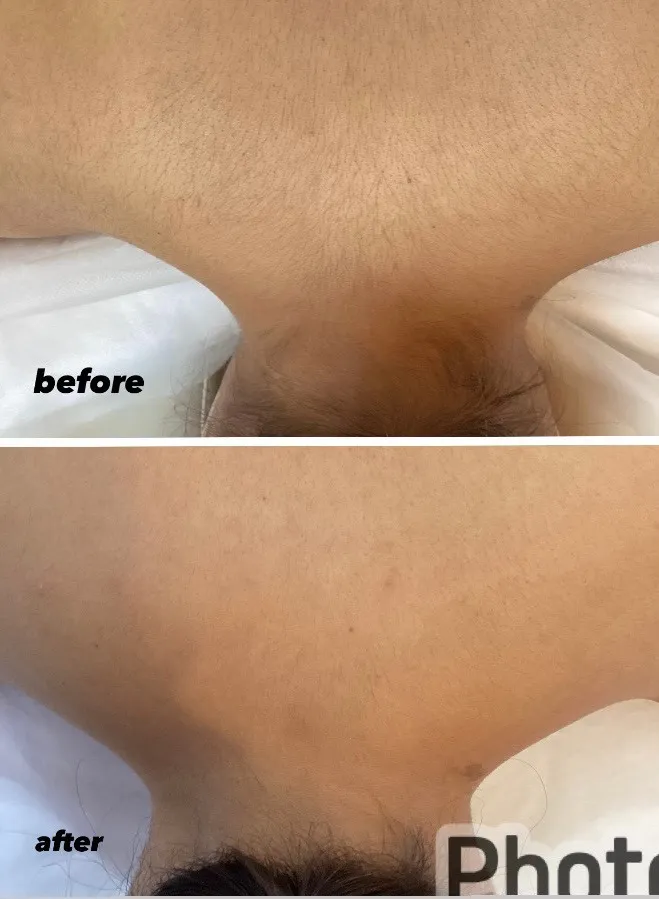 宮崎市エステ 脱毛