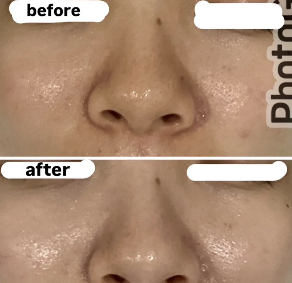 宮崎市エステ　美顔・毛穴洗浄