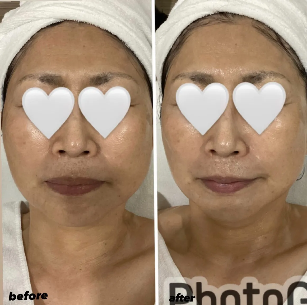 宮崎市エステ 肌の変化✨️