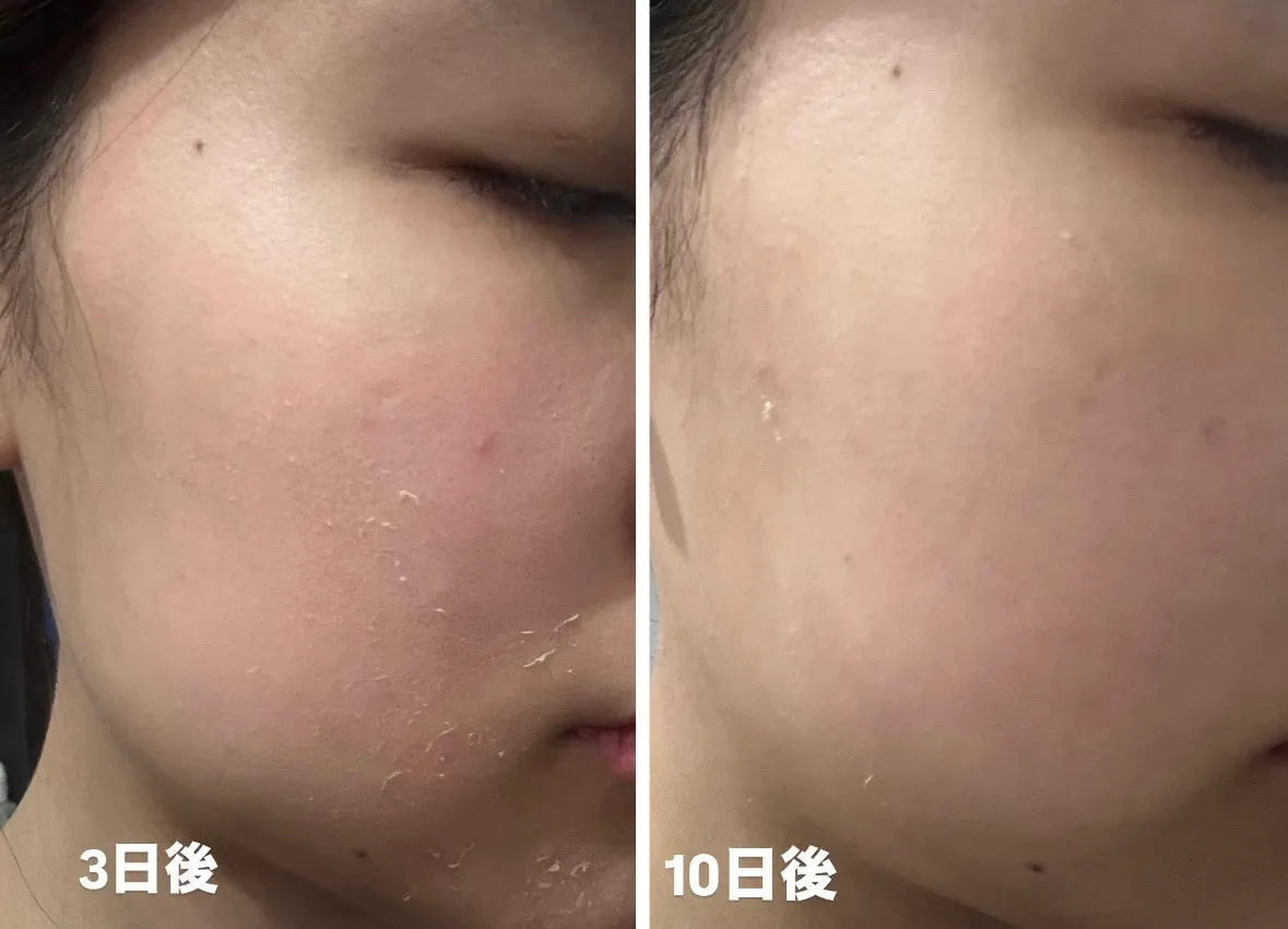 宮崎市エステ　ゴールドセラム変化✨