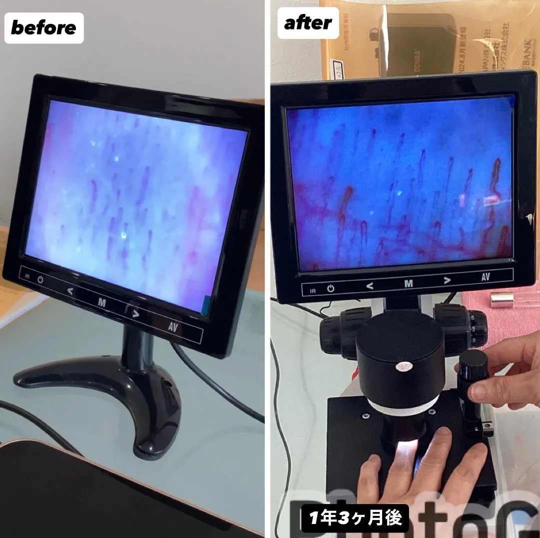 宮崎市エステ　デンバ変化