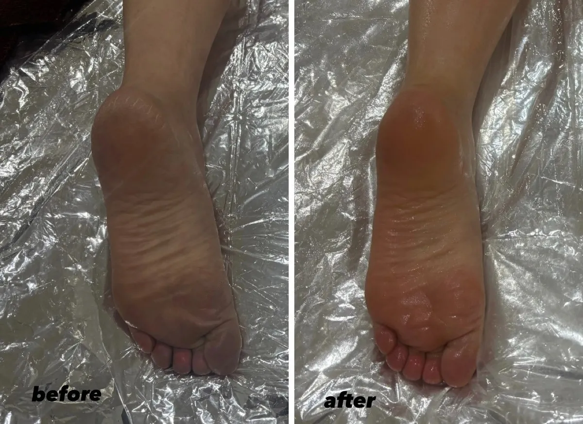 宮崎市エステ　痩身