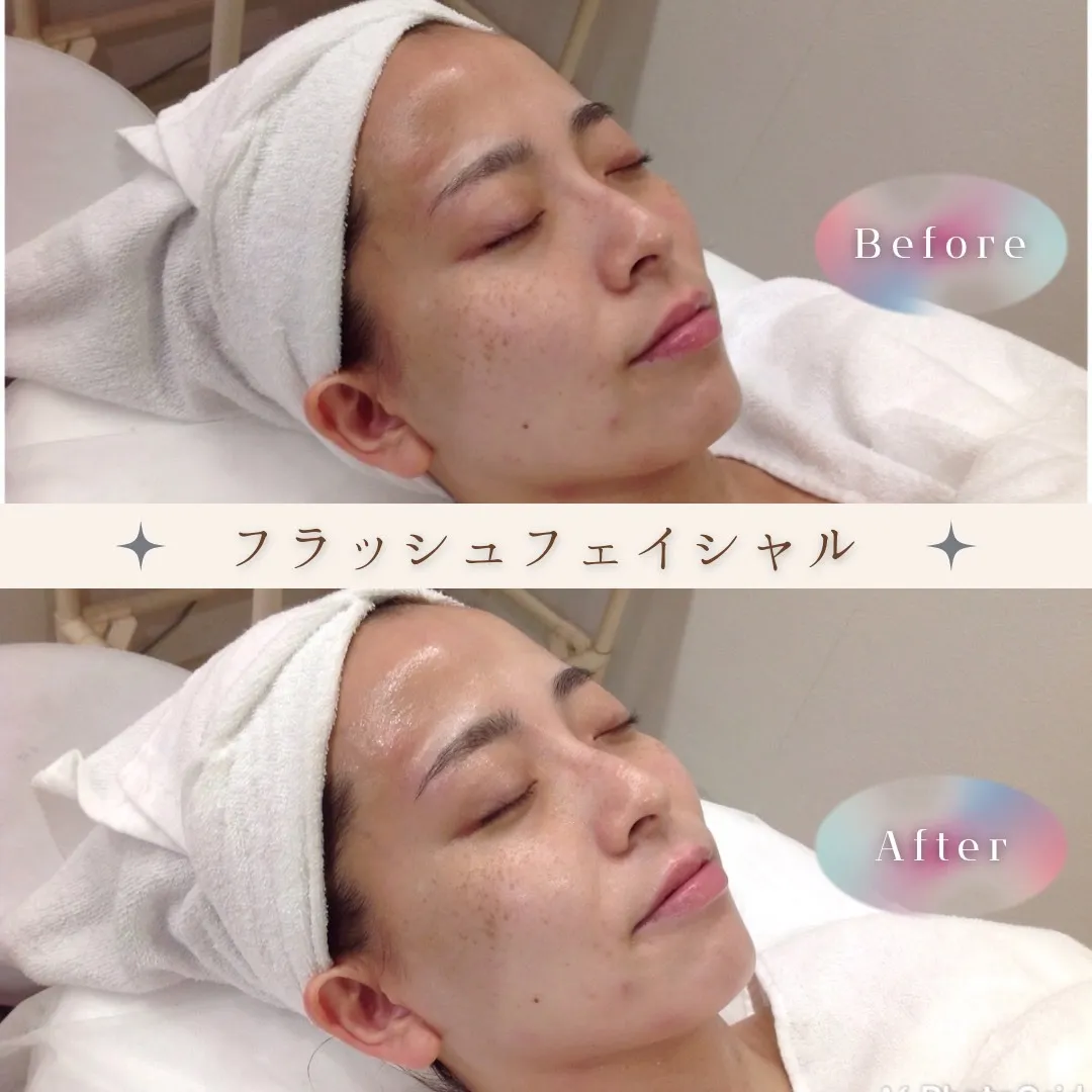 エステワム熊本　フラッシュフェイシャル♡